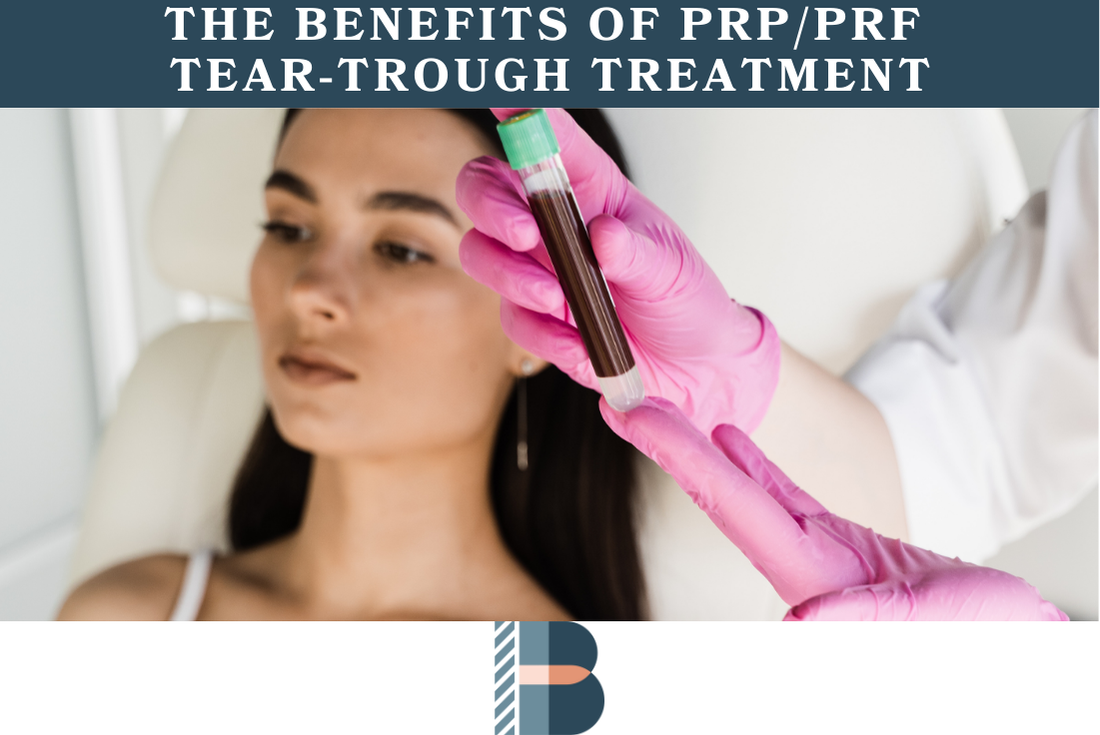The Benefits of PRPPRF Tear-Trough Treatment 1