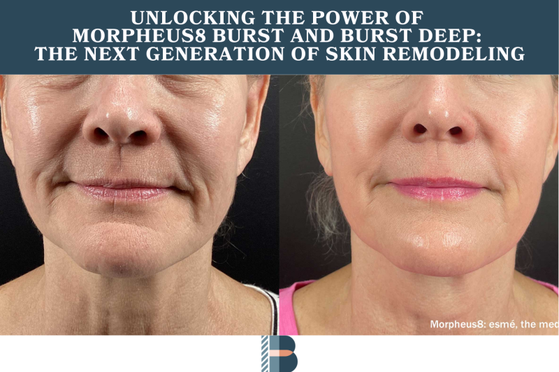 Unlocking the Power of Morpheus8 Burst and Burst Deep The Next Generation of Skin Remodeling