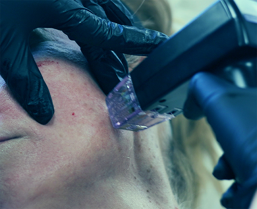 Morpheus8 RF microneedling in Jericho NY at Bespoke Medesthetics