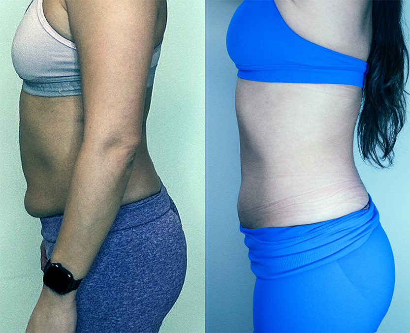 Medical weight loss program in Jericho NY at Bespoke Medesthetics